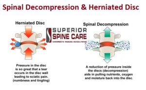 Spinal Decompression Therapy in North Olmsted