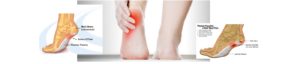 plantar fasciitis physical therapy